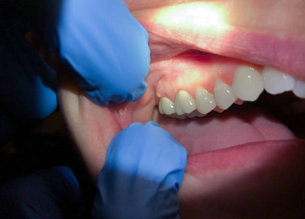Best Emergency Dental Care for Broken or Chipped Teeth in Coppell, TX